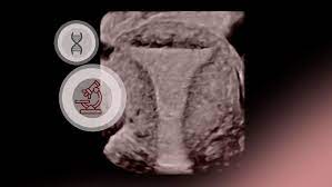 Genomische biomarker voor de diagnose van endometriose met behulp van speeksel: Een doorbraak in niet-invasieve testen