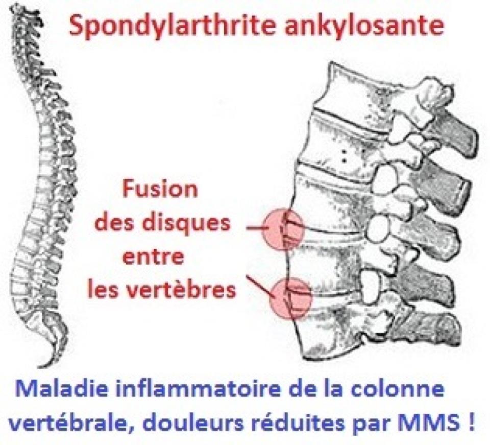 RINVOQ® (upadacitinib) goedgekeurd door de Europese Commissie als orale behandeling voor volwassenen met niet-radiografisch actieve axiale spondyloartritis