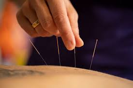 Stoppen Met Roken Acupunctuur
